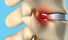 cirurgia-da-coluna-minimamente-invasiva-e-possivel pablo-sobreiro