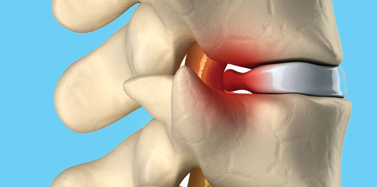 cirurgia-da-coluna-minimamente-invasiva-e-possivel pablo-sobreiro
