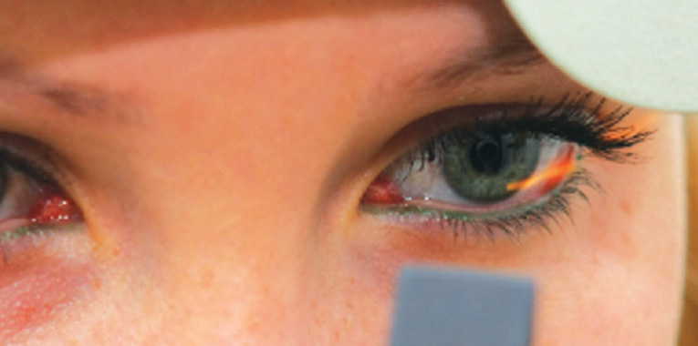 cirurgia-de-catarata+hospital-barigui