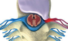 hernia-de-disco-e-a-maior-causa-de-dor-ciatica+itc