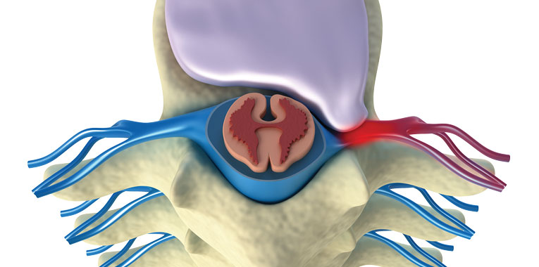 hernia-de-disco-e-a-maior-causa-de-dor-ciatica+itc