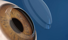 solucoes-para-o-ceracotone+barigui