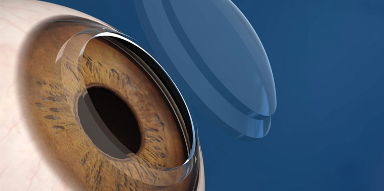 solucoes-para-o-ceracotone+barigui