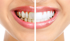 dentes+clareamento+odontologia-estetica+adriane-paglia_